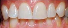 Bild Zahnarztpraxis Dr. Wittern: Vor dem Bleaching
