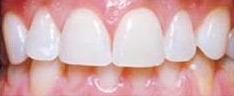 Bild Zahnarztpraxis Dr. Wittern: Nach dem Bleaching