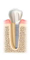 Bild Zahnarztpraxis Dr. Wittern Implantat